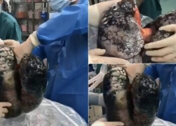 Kështu duken mushkëritë e duhanpirësit që piu një pako në ditë për 30 vjet