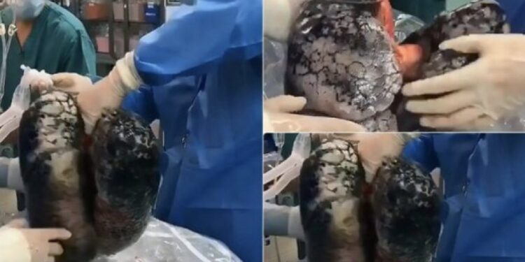 Kështu duken mushkëritë e duhanpirësit që piu një pako në ditë për 30 vjet