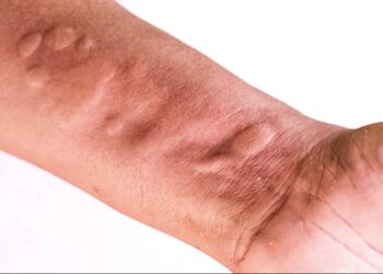 Mjekët shpjegojnë se çfarë ndodh me trupin tuaj nëse shfaqet kjo gjendje shëndetësore