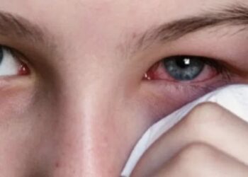 Nëse ju skuqen sytë po ju paralajmërojnë për këtë sëmundje