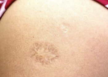 Nëse e keni marrë këtë vaksinë jeni më pak të rrezikuar nga koronavirusi