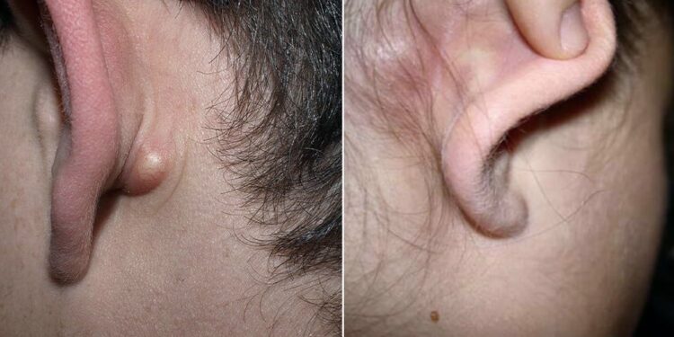 Nëse keni këso lloj gungash në qafë ose pas veshit, duhet ta lexoni këtë