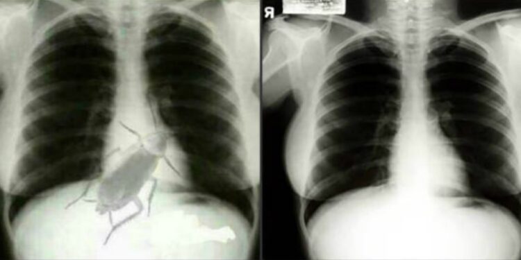 I thanë se ka një lloj buburreci në kraharor, por doli krejt tjetër gjë