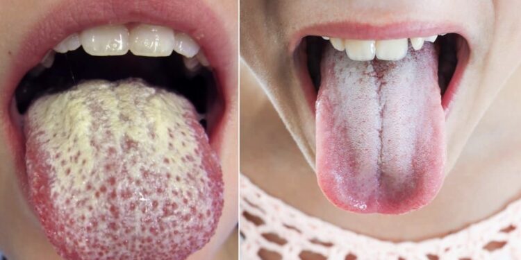 Gjuha e bardhë dhe barku i fryrë paralajmërojnë këtë sëmundje
