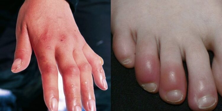 Përse disa njerëzve u shfaqet morthi në dimër? Cilat janë kushtet që e favorizojnë?