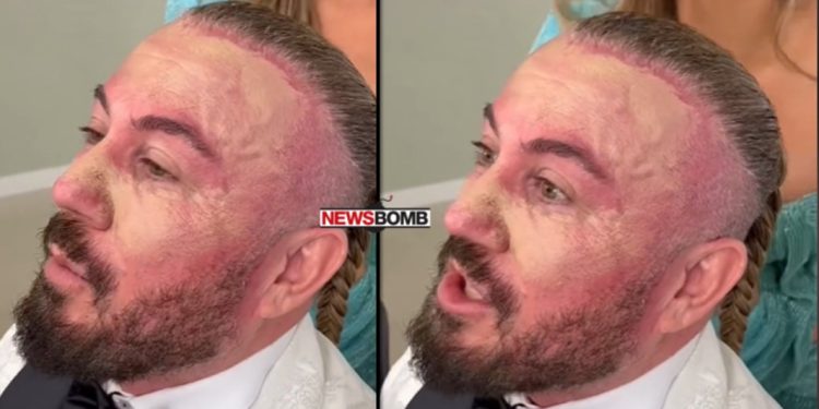 Çfarë ndodhi me Sabianin? Këngëtari digjet në fytyrë vetëm pak para finales