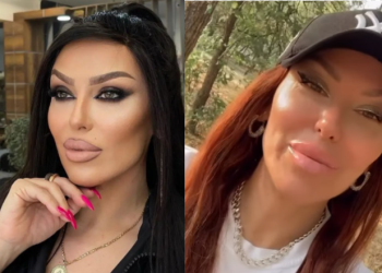 Ҫfarë ka ndodhur me fytyrën e Arta Bajramit / Këngëtarja habit fansat