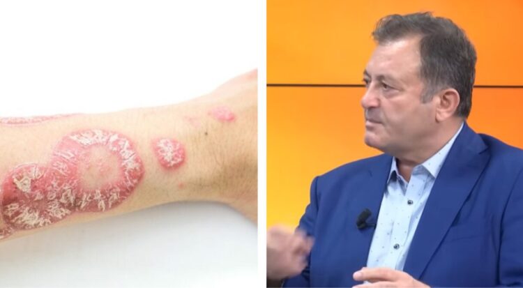 Specialisti Ylli Merja : Pse shkaktohet psoriaza dhe ja si mund ta kuroni njëherë e përgjithmonë me bimë medicinale