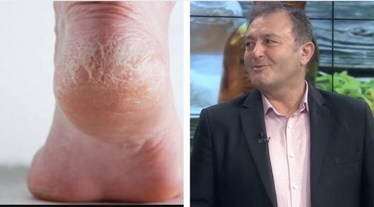 Shpëtoni njëherë e përgjithmonë nga kallot e këmbëve, thembrat e plasaritura dhe të çara. Ylli Merja: Ja kurat natyrale që mund ti bëni vetë në shtëpi dhe…