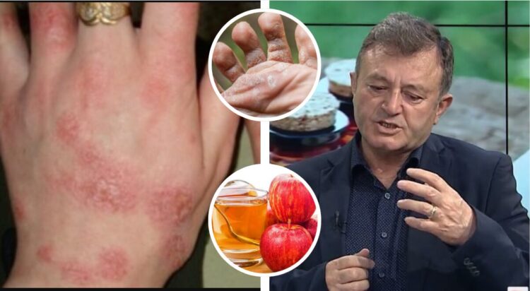 Luftojeni mykun në kohë rekord vetëm me këto produkte që keni në shtëpi / Ylli Merja: 100 % efektive