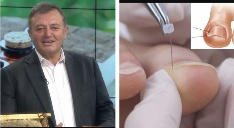 Ju futen thonjtë në mish? Ylli Merja tregon kurën natyrale që do tju shpetoje vetem ne pak dite…
