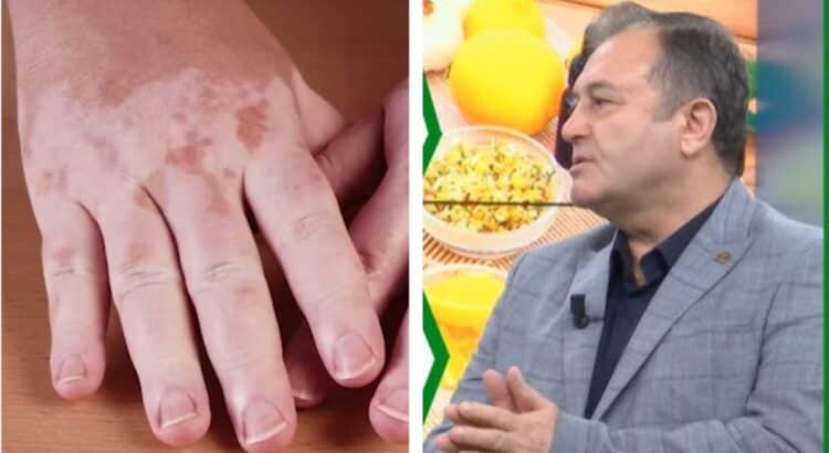 Ylli Merja: Si të kuroni mykun e lëkurës me rigonin e bardhë: Kur myku është në sipërfaqe, lëkurë…