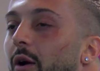 Kështu duket Gjesti, pas goditjes nga Jozi